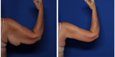 Case 6984 - 45-54 year old woman treated with Arm Lift