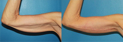 Case 6993 - Woman treated with Arm Lift