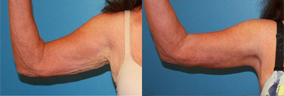 Case 6994 - Woman treated with Arm Lift