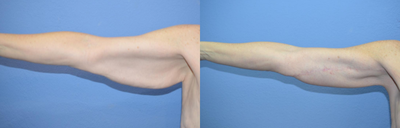 Case 6995 - 55-64 year old woman treated with Arm Lift