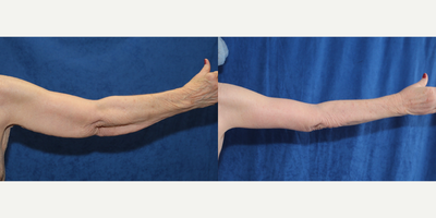 Case 6996 - 75 and up year old woman treated with Arm Lift