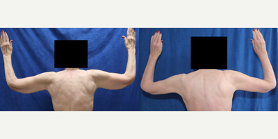 Case 6997 - 75 and up year old woman treated with Arm Lift