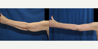 Case 6998 - 75 and up year old woman treated with Arm Lift