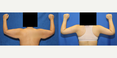 Case 6999 - 35-44 year old woman treated with Arm Lift