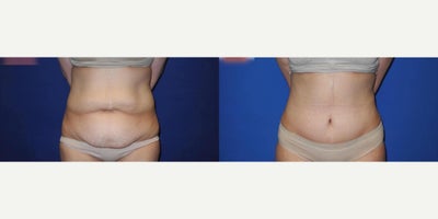 Case: 7 - before and after photo of Woman treated with Tummy Tuck by Shahram Salemy, MD, FACS