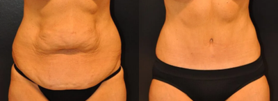 Case 70 - Woman treated with Tummy Tuck