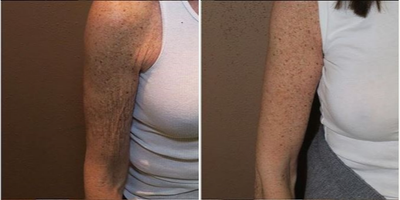 Case 7001 - Woman treated with Arm Lift