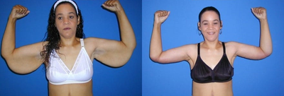 Case 7002 - Woman treated with Arm Lift