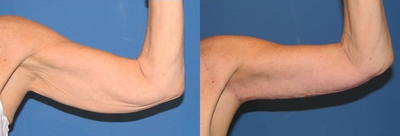 Case 7003 - Woman treated with Arm Lift