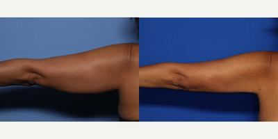Case 7004 - 51 year old woman treated with Liposuction, Arm Lift