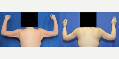 Case 7005 - 35-44 year old woman treated with Arm Lift