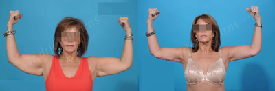 Case 7006 - Woman treated with Arm Lift