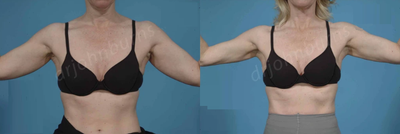 Case 7007 - Woman treated with Arm Lift