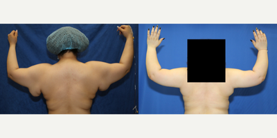 Case 7010 - 25-34 year old woman treated with Arm Lift