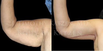 Case 7012 - Woman treated with Arm Lift