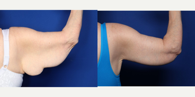 Case 7014 - 55-64 year old woman treated with Arm Lift