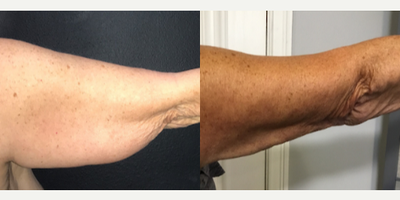 Case 7015 - Woman treated with Arm Lift