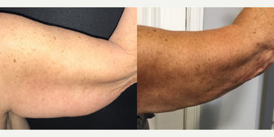 Case 7016 - Woman treated with Arm Lift