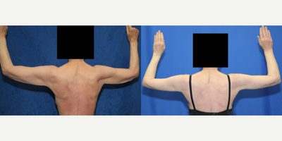 Case 7017 - 65-74 year old woman treated with Arm Lift