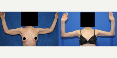 Case 7018 - 65-74 year old woman treated with Arm Lift
