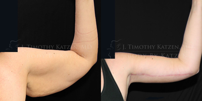 Case 7019 - Woman treated with Arm Lift