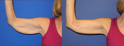 Case 7022 - Arm Lift