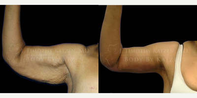 Case 7023 - Woman treated with Arm Lift