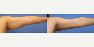 Case 7024 - Woman treated with Arm Lift