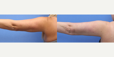 Case 7025 - Woman treated with Arm Lift