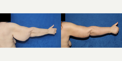 Case 7026 - 55-64 year old woman treated with Arm Lift