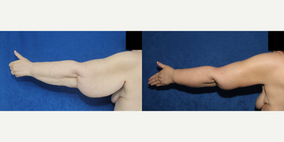 Case 7027 - 55-64 year old woman treated with Arm Lift