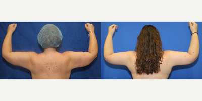 Case 7028 - 25-34 year old woman treated with Arm Lift