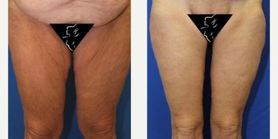 Case: 7029 - before and after photo of 45-54 year old woman treated with Thigh Lift by J. Timothy Katzen, MD, FACS
