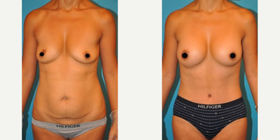 Case 703 - Woman treated with Tummy Tuck