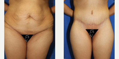 Case: 7030 - before and after photo of 25-34 year old woman treated with Thigh Lift by J. Timothy Katzen, MD, FACS