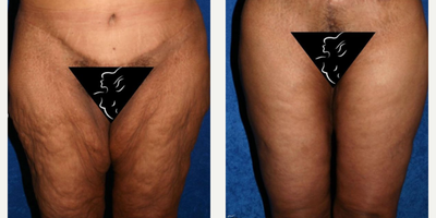 Case: 7031 - before and after photo of 55-64 year old woman treated with Thigh Lift by J. Timothy Katzen, MD, FACS
