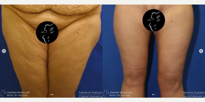 Case: 7032 - before and after photo of 45-54 year old woman treated with Thigh Lift by J. Timothy Katzen, MD, FACS