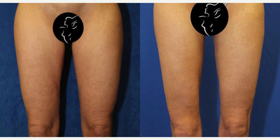 Case: 7033 - before and after photo of 35-44 year old woman treated with Thigh Lift by J. Timothy Katzen, MD, FACS