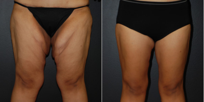 Case: 7035 - before and after photo of Woman treated with Thigh Lift by Robert L. Steely, MD, FACS