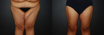 Case: 7036 - before and after photo of Woman treated with Thigh Lift by Robert L. Steely, MD, FACS
