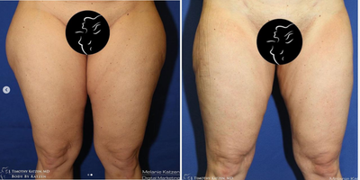 Case: 7037 - before and after photo of 25-34 year old woman treated with Thigh Lift by J. Timothy Katzen, MD, FACS