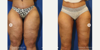 Case 7038 - 25-34 year old woman treated with Thigh Lift