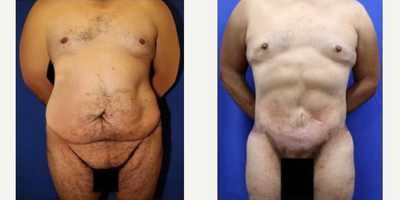 Case 7039 - Thigh Lift