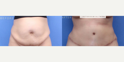 Case 704 - Woman treated with Tummy Tuck