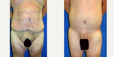 Case 7040 - 35-44 year old woman treated with Thigh Lift
