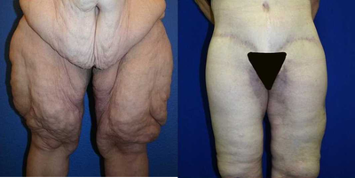 Case 7041 - 45-54 year old woman treated with Thigh Lift