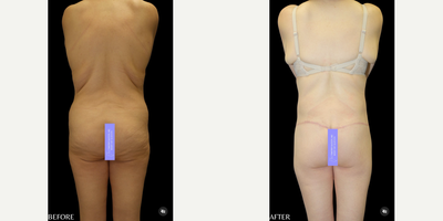 Case 7042 - 35-44 year old woman treated with Thigh Lift