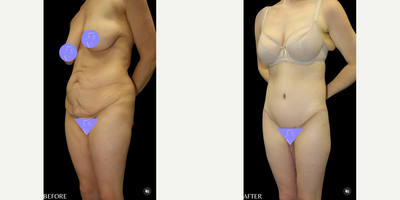 Case 7043 - 35-44 year old woman treated with Thigh Lift