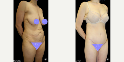 Case 7044 - 35-44 year old woman treated with Thigh Lift