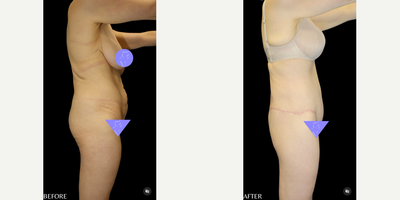 Case 7045 - 35-44 year old woman treated with Thigh Lift